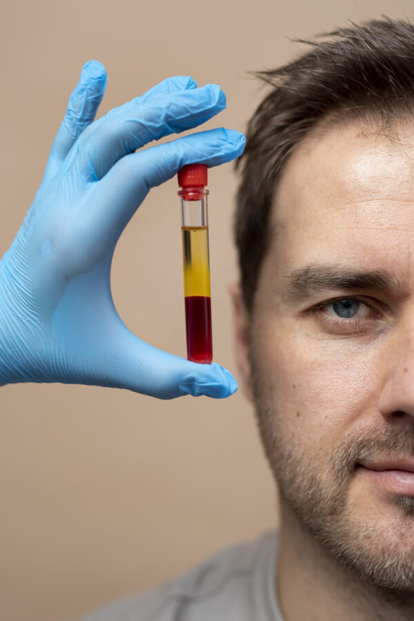 Platelet-rich plasma (PRP)